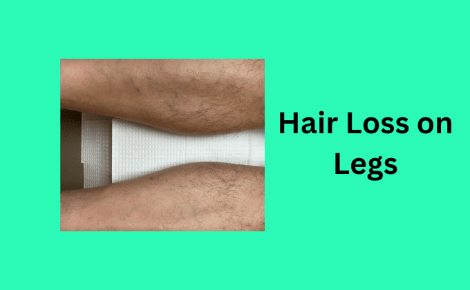 Hair Loss on Legs