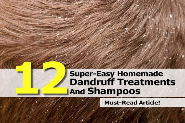 Before reading on about treating your dandruff at home, make sure you actually have dandruff.  If you believe you have dandruff, than read on. Here are 12 homemade dandruff treatments to help you kick the crusties.