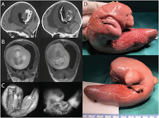 МРТ-изображения плода внутри черепа младенца рядом с удаленными фотографиями плода.
