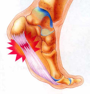 <img alt='HEEL PAIN FOOT' src='http://i49.tinypic.com/2960x7q.jpg'/>