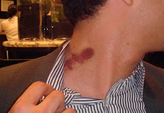 hickey tattoo