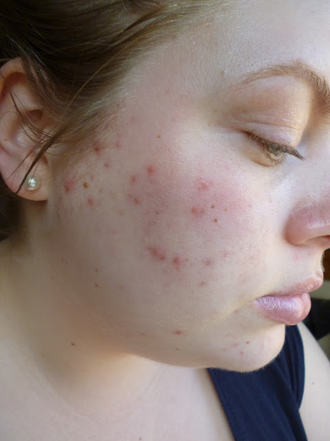 Picture Of Person With Skin Blemishes