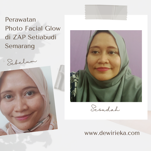 Perawatan Photo Facial Glow di ZAP Clinic Setiabudi Semarang