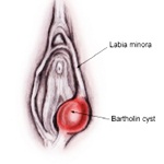 Tentang Kisata Bartholin