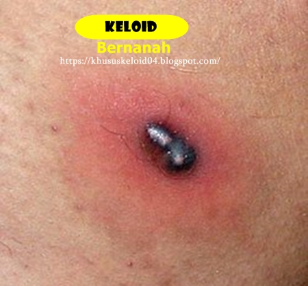 Keloid Bernanah Dan Cara Mengobatinya Dengan Cepat