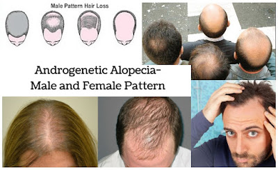 Androgenetic Alopecia Patterns