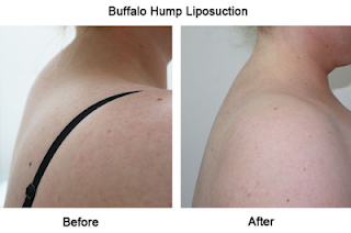 Buffalo Hump On Neck Removal