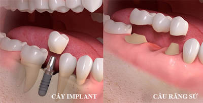 Cấy ghép răng implant để làm gì?