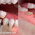 Cấy ghép răng implant để làm gì?