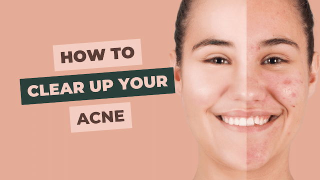 How to Clear Up Your Acne : The 7 Simple Ways To Get Rid Of Acne