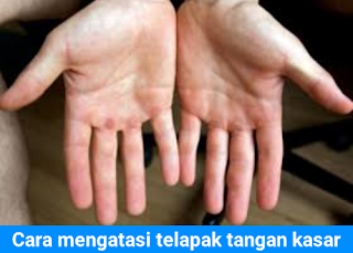 Cara menghaluskan telapak tangan yang sangat kasar dengan cepat menggunakan bahan alami