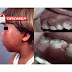 Infecciones odontogénicas: Criterios de hospitalización y etapas clínicas 