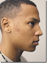 acne