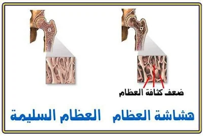 هشاشة العظام الأسباب والأعراض والعلاج