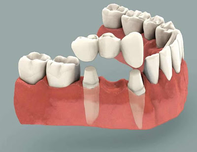 Trồng răng giả mất bao lâu với cầu răng sứ? 1