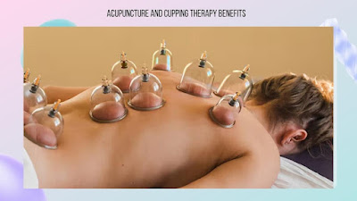 Acupuncture and cupping therapy benefits