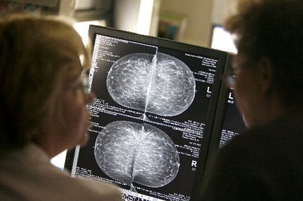 mammogram images of breast cancer. chair of the Breast Cancer