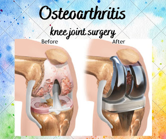 Osteoarthritis knee joint surgery