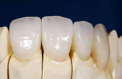 Bọc răng sứ có tác hại gì không?