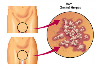 Penyakit Kelamin Herpes