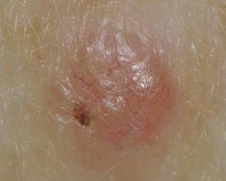 basal cell carcinoma skin cancer