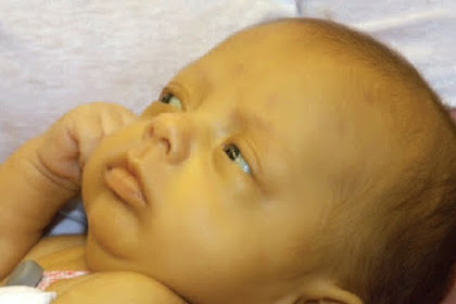 Ibu Muda Tidak Perlu Khawatir, Ini Penyebab Bayi Berwarna Kuning Dan Cara Menanganinya