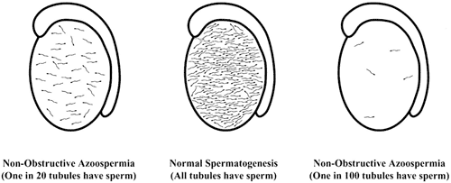 Obat Azoospermia Sperma Kosong