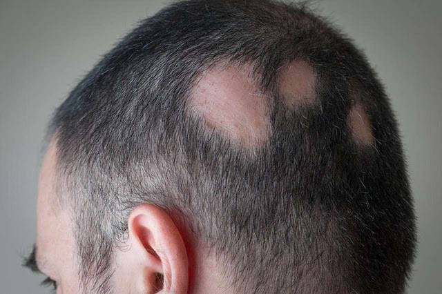 Geralmente em casos de alopecia areata, a perda de cabelo pode não ser permanente, porque os folículos pilosos não são destruídos, mas sim colocados em um estado de repouso