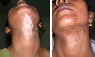 Vitiligo Plastic Surgery