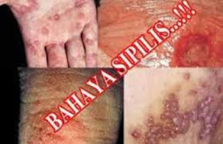 inilah obat sipilis pria wanita yang paling bagus di apotik