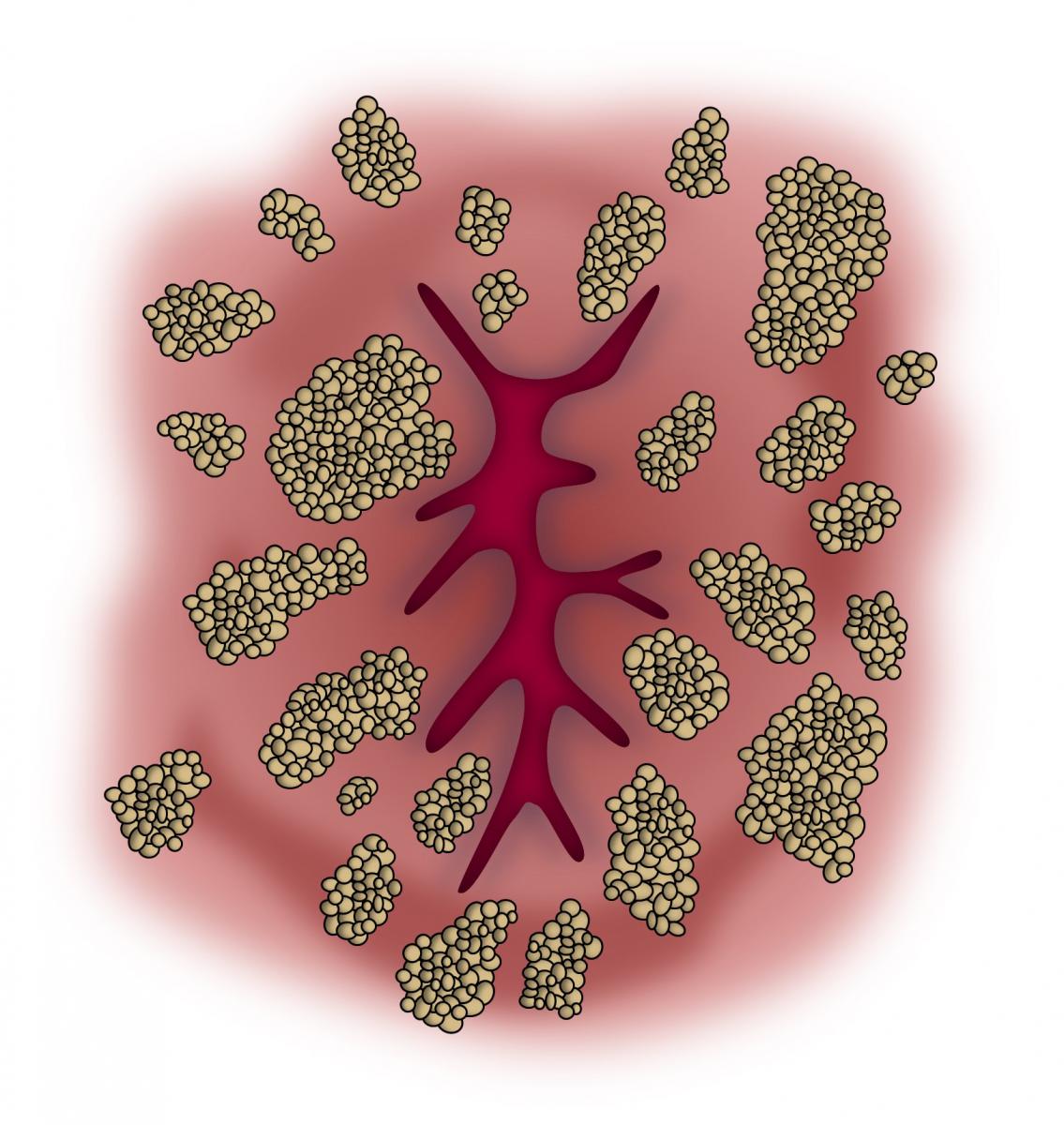 Virus Kutil Kelamin