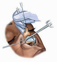 Açık teknik burun estetiği (açık teknik rinoplasti / açık teknik SRP / open rhinoplasty)