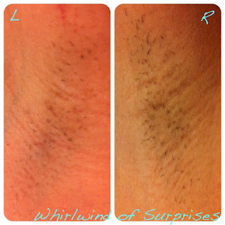 After 3 months of using Tria laser hair removal