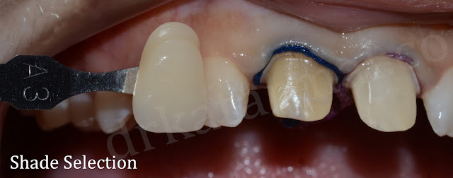 Preparation of Teeth and Shade Selection