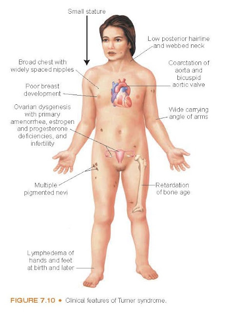 Clinical features of Turner syndrome.