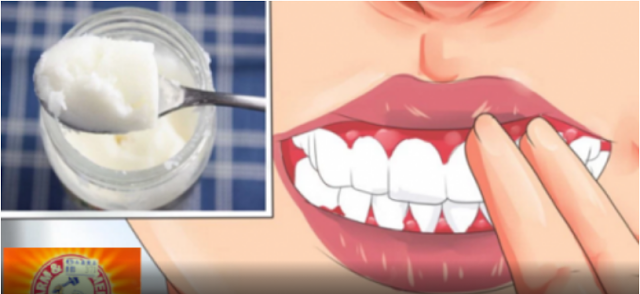 How To Cure Gingivitis With Coconut Oil, Baking Soda And Lemons