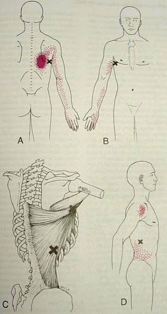 MIOTERAPIA