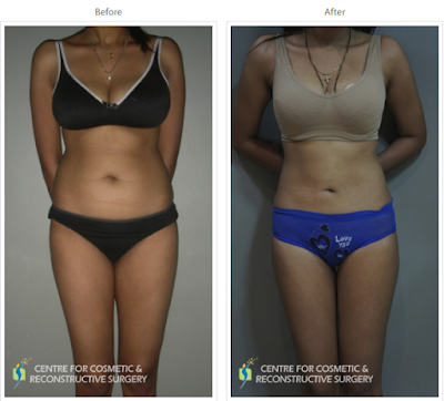 Liposuction in Mumbai