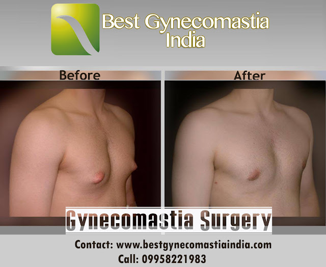 gynecomastia surgery, male breast reduction surgery,  best gynecomastia treatment in Delhi, cost of gynecomastia surgery in india, best gynecomastia india, best gynecomastia surgeon india, #gynecomastia, #gynecomastiacost, #malebreastsurgery, #gynecomastiaclinic, #puffynipplesurgery