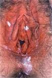  imagen 2 infección vaginal, como curar tricomoniasis vaginal