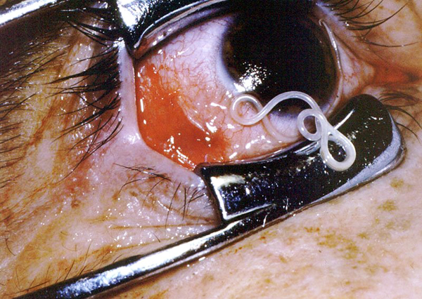 Loa loa, gusano del ojo africano, siendo extraido de los ojos de un paciente | Ximinia