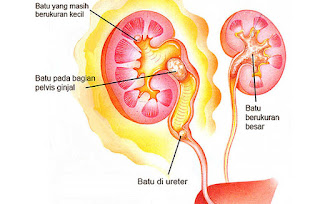 penyakit kencing batu