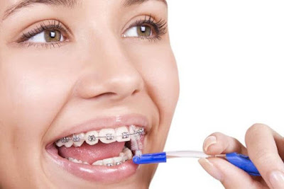 Phân tích niềng răng có ảnh hưởng gì không từ nha sĩ-2