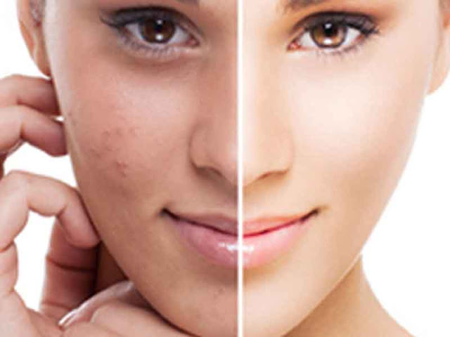 dark spots of skin care during acne