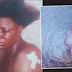 Photo of the nipple that was bitten off and swallowed during a fight in Lagos 