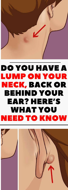 DO YOU HAVE A LUMP ON YOUR NECK, BACK OR BEHIND YOUR EAR? HERE’S WHAT YOU NEED TO KNOW