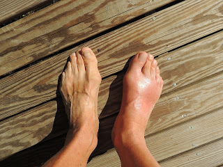 swelling in feet gout