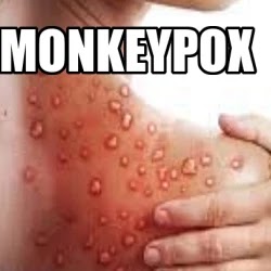 monkeypox . monkeypox  9 misconceptions - a new but old disease