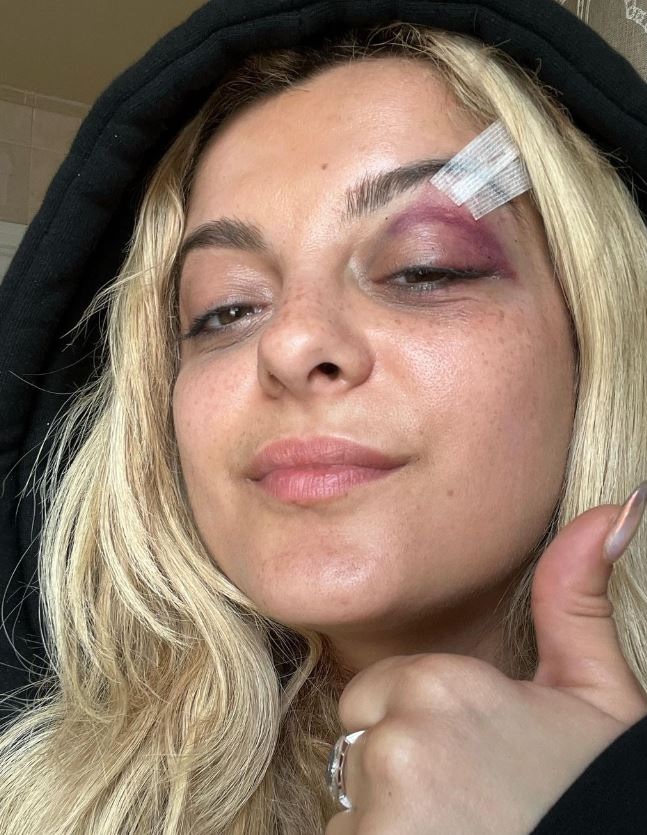 Bebe Rexha posta di com'è dopo 3 punti di sutura in faccia