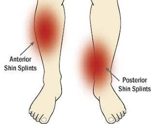 Shin Splint Pain Locations